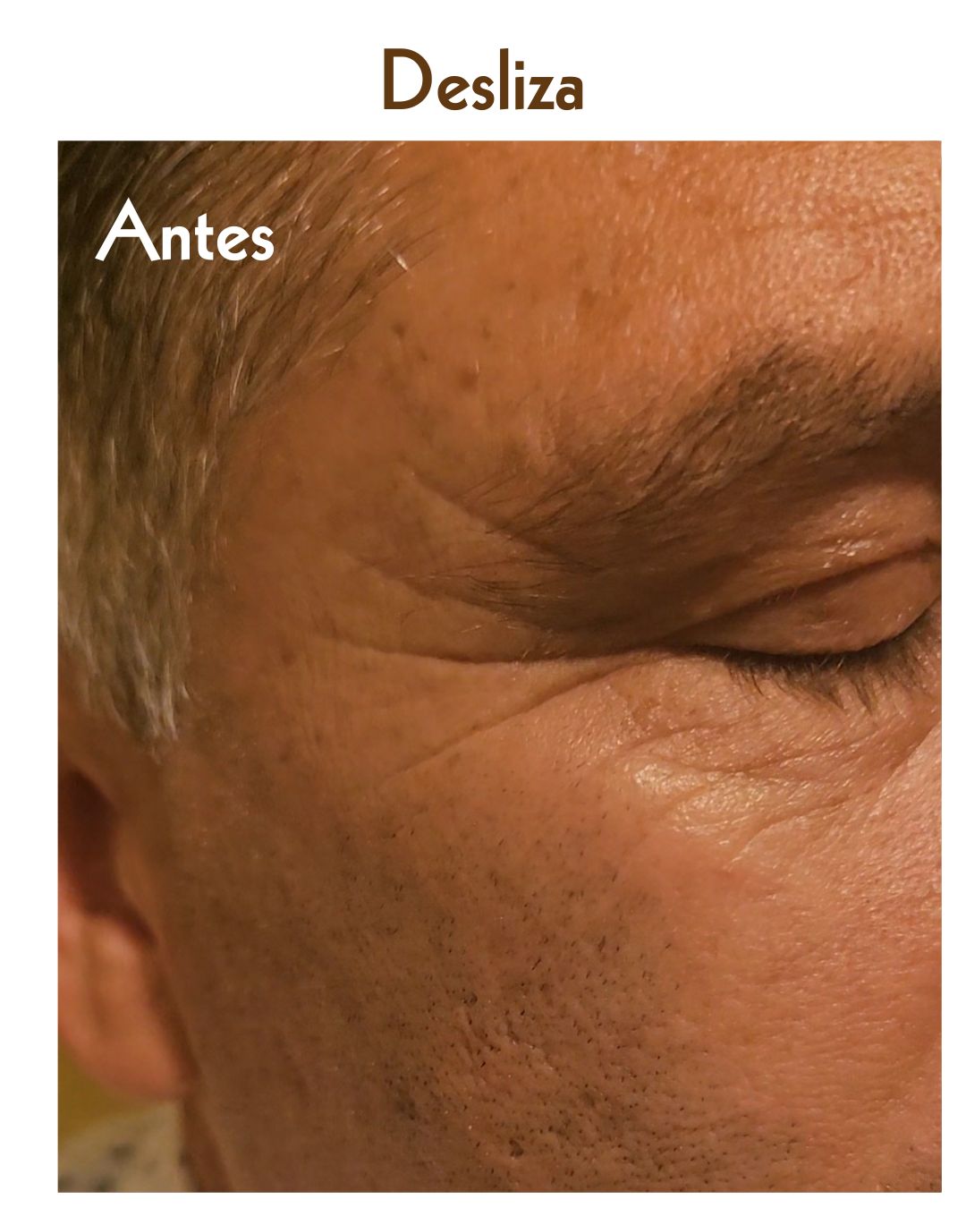 PlasmaBIogel Filler, tratamiento no invasivo que reduce las líenas profundas en pacientes de edad madura que aún nunca se hayan realizado previos tratamientos faciales.