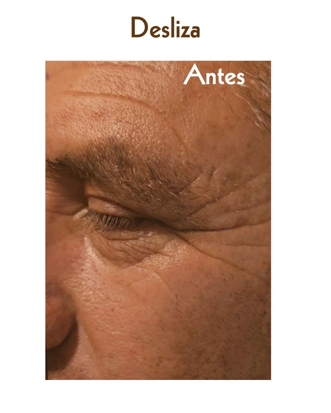 Líneas de expresión marcadas, no existen tratamientos previos, primer tratamiento facial