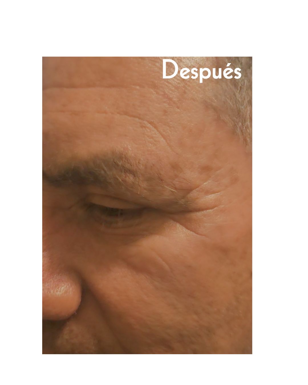 Piel más hidratada, menos líneas de expresión, tratamiento no invasivo.