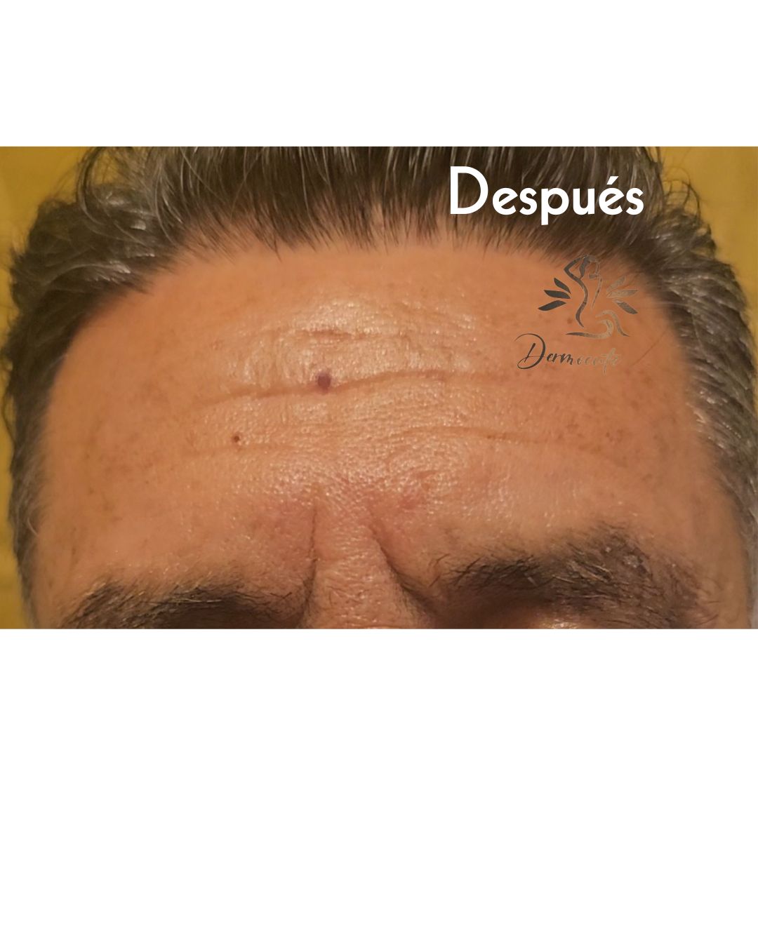 PlamaBioGel Tratamiento de rejuvenecimiento ideal para aquellos que NUNCA antes se han realizado ningún tratamiento previo, recupera la elasticidad, minimiza arrugas, aún las más profundas, paciente de 62 años.