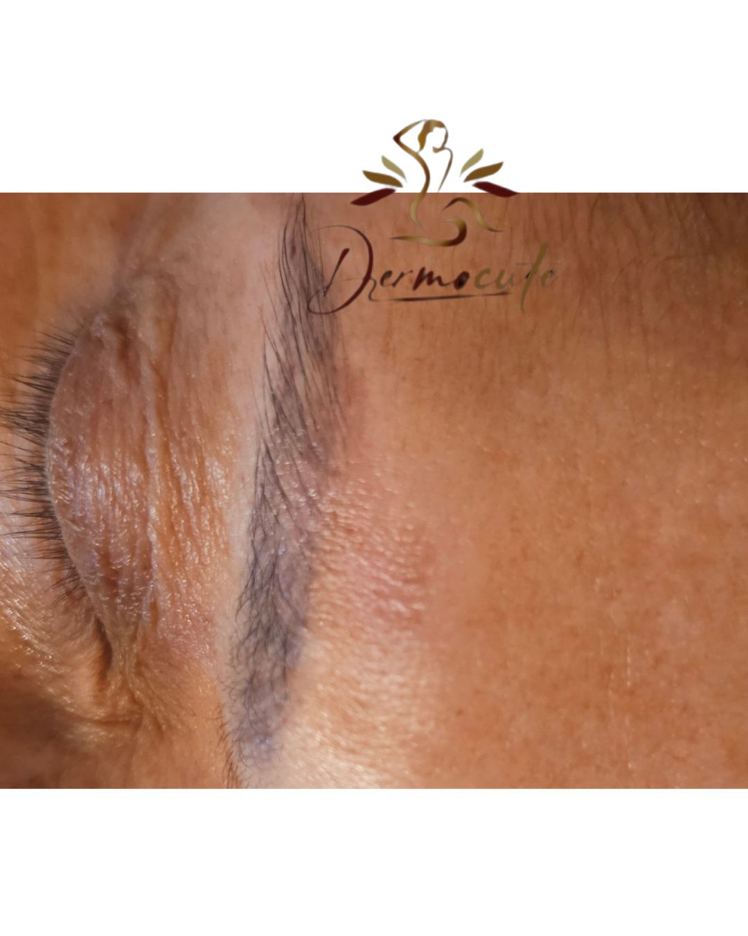 Eliminación casi total en apenas 3 sesiones