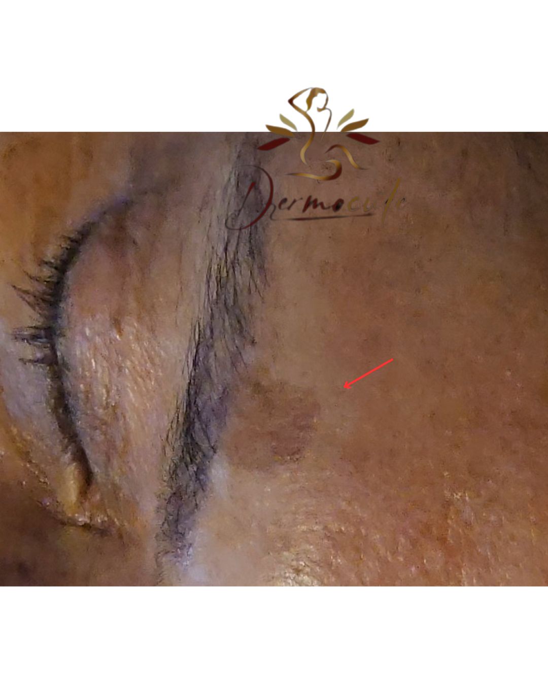 Léntigo solar crónico sobre ceja