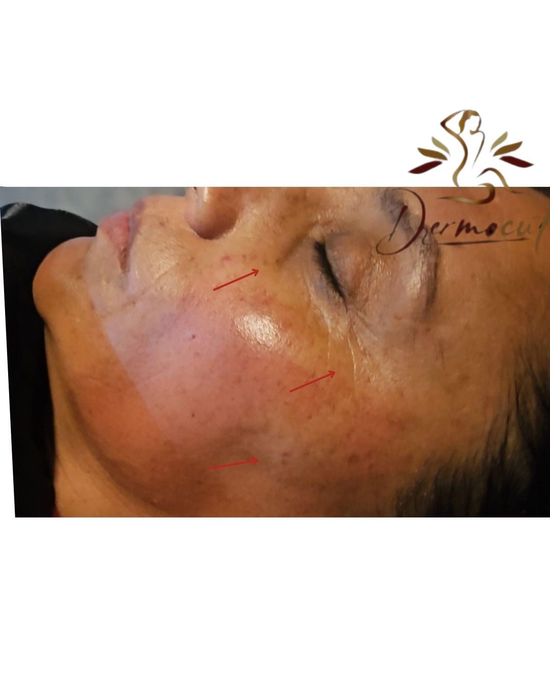 Léntigos solares rostro y nariz, arrugas