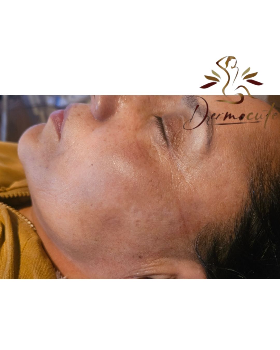 TRatamiento integral elimina manchas y disminuye arrugas