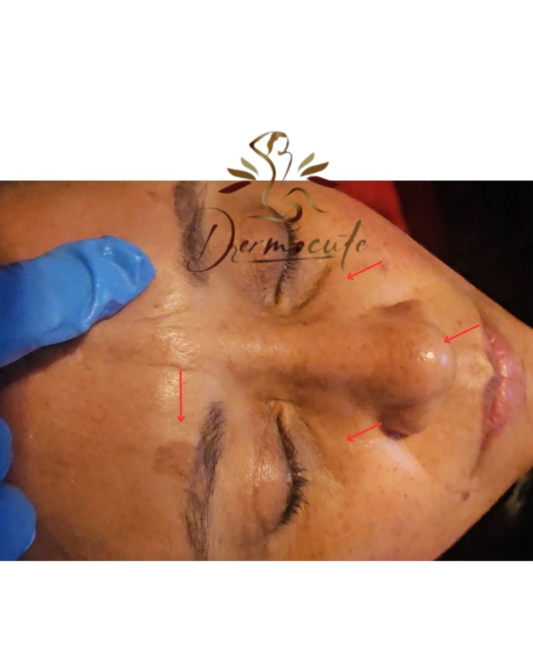 Lesiones pigmentarias en todo el rostro